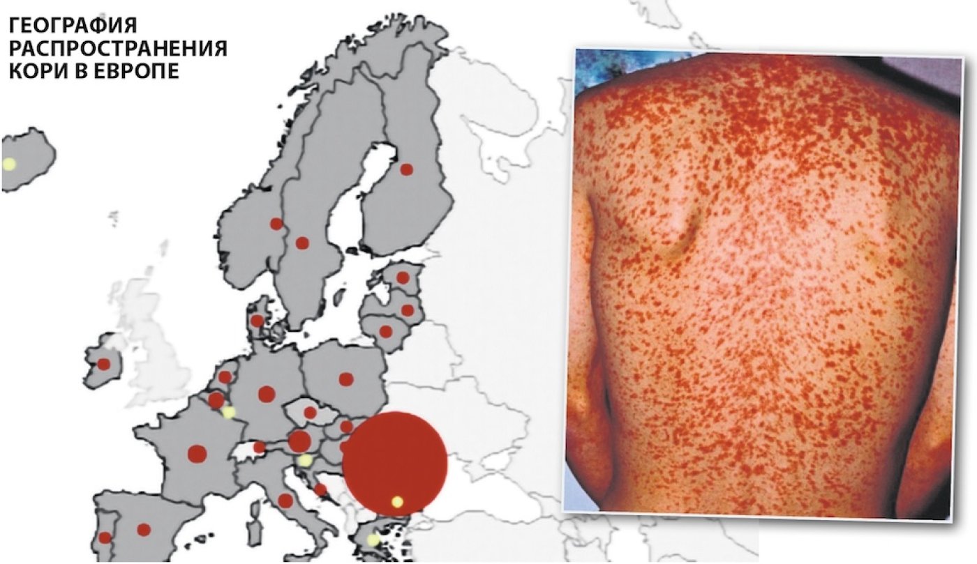 Корь в Эстонии: кто находится в зоне риска и как избежать заражения?